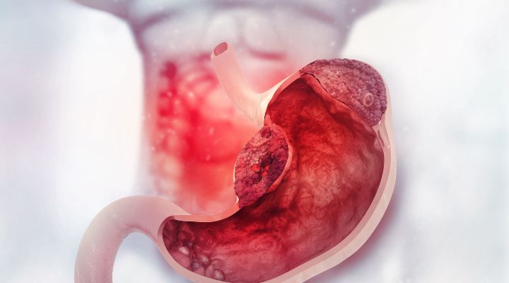 STOMACH CANCER A SILENT KILLER: Here Are The Signs & Symptoms